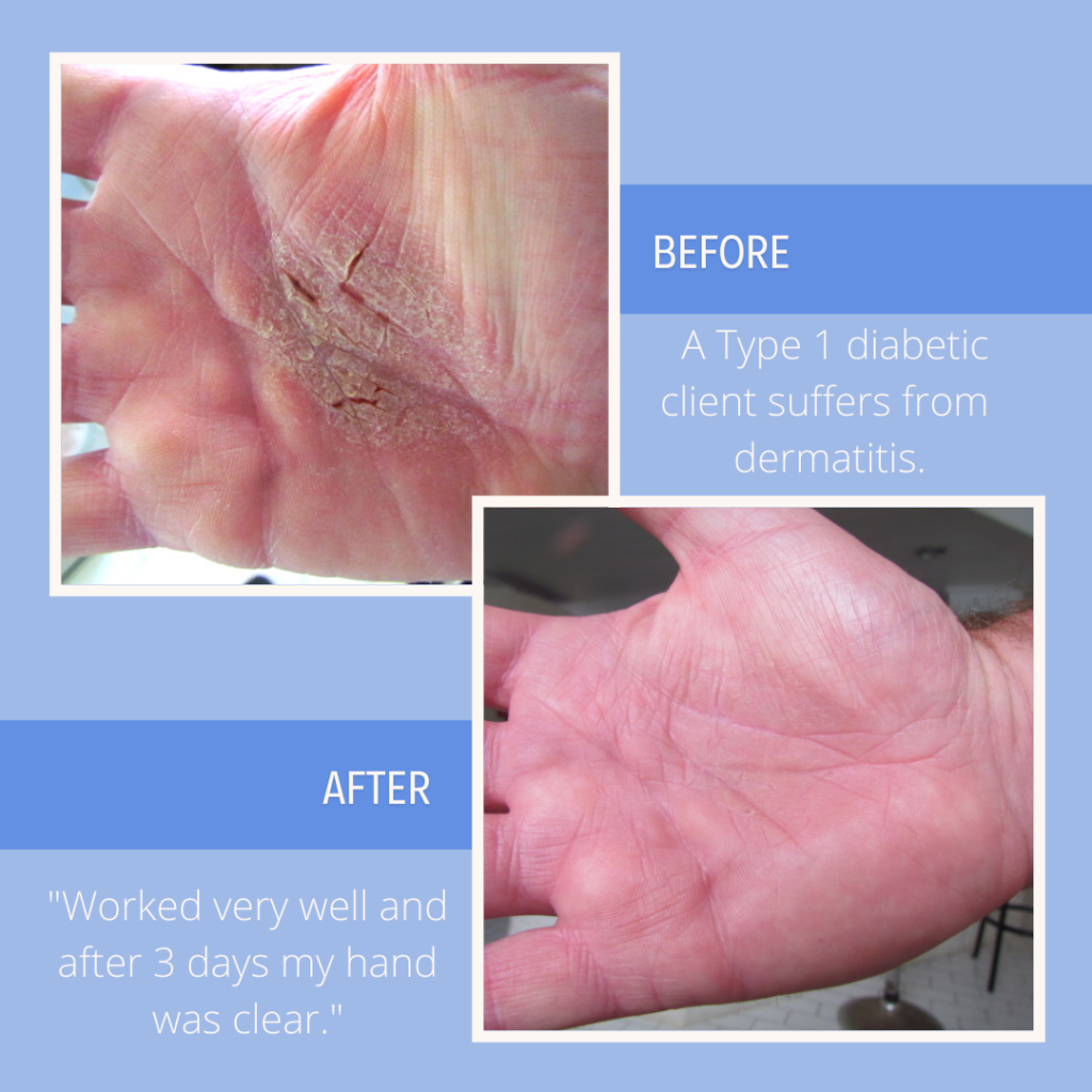 10 Diabetic Skin Conditions Part 1