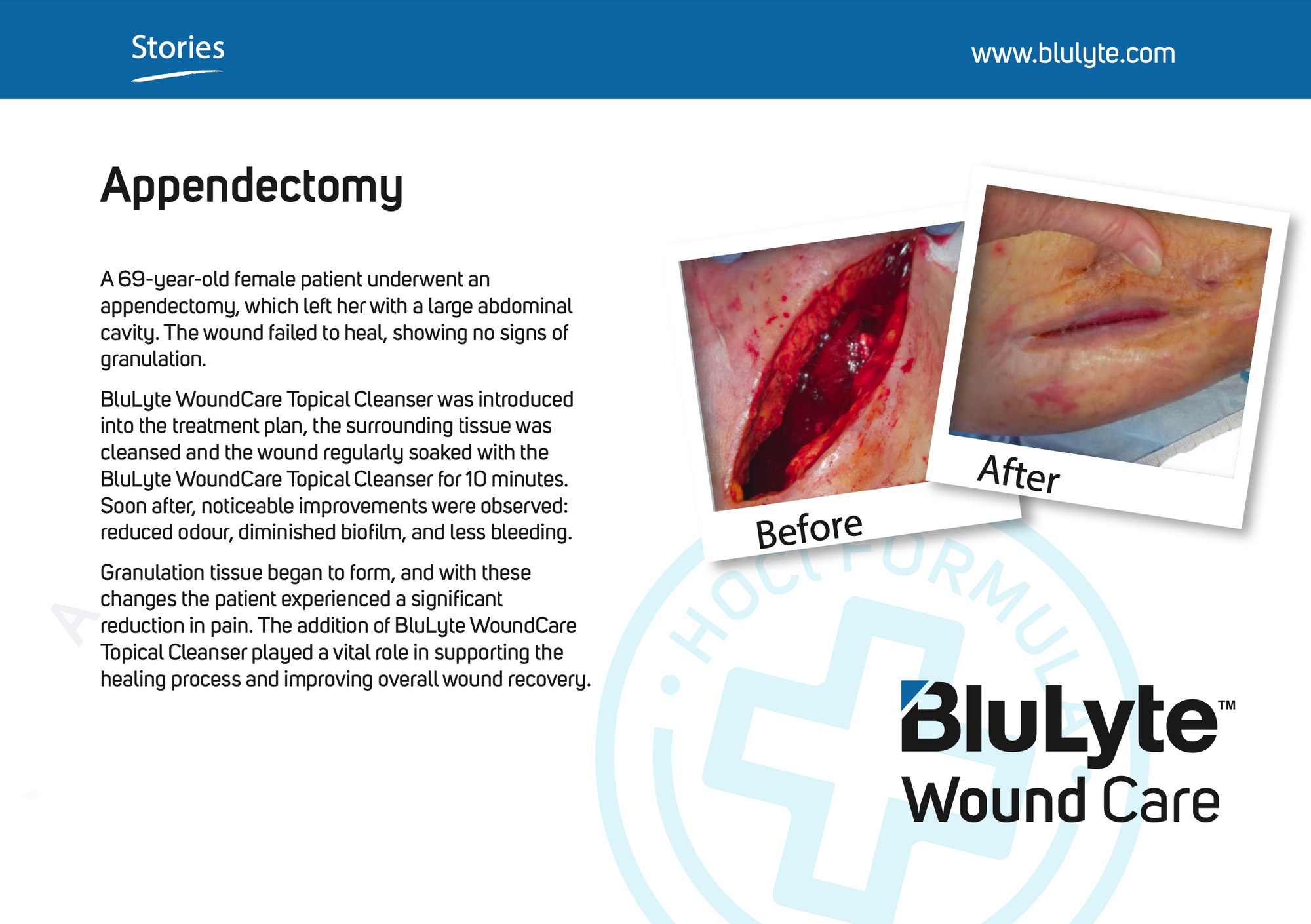 Case Study for BluLyte Wound Care showing 'Before' and 'After' images of an appendectomy patient. Hypochlorous Acid