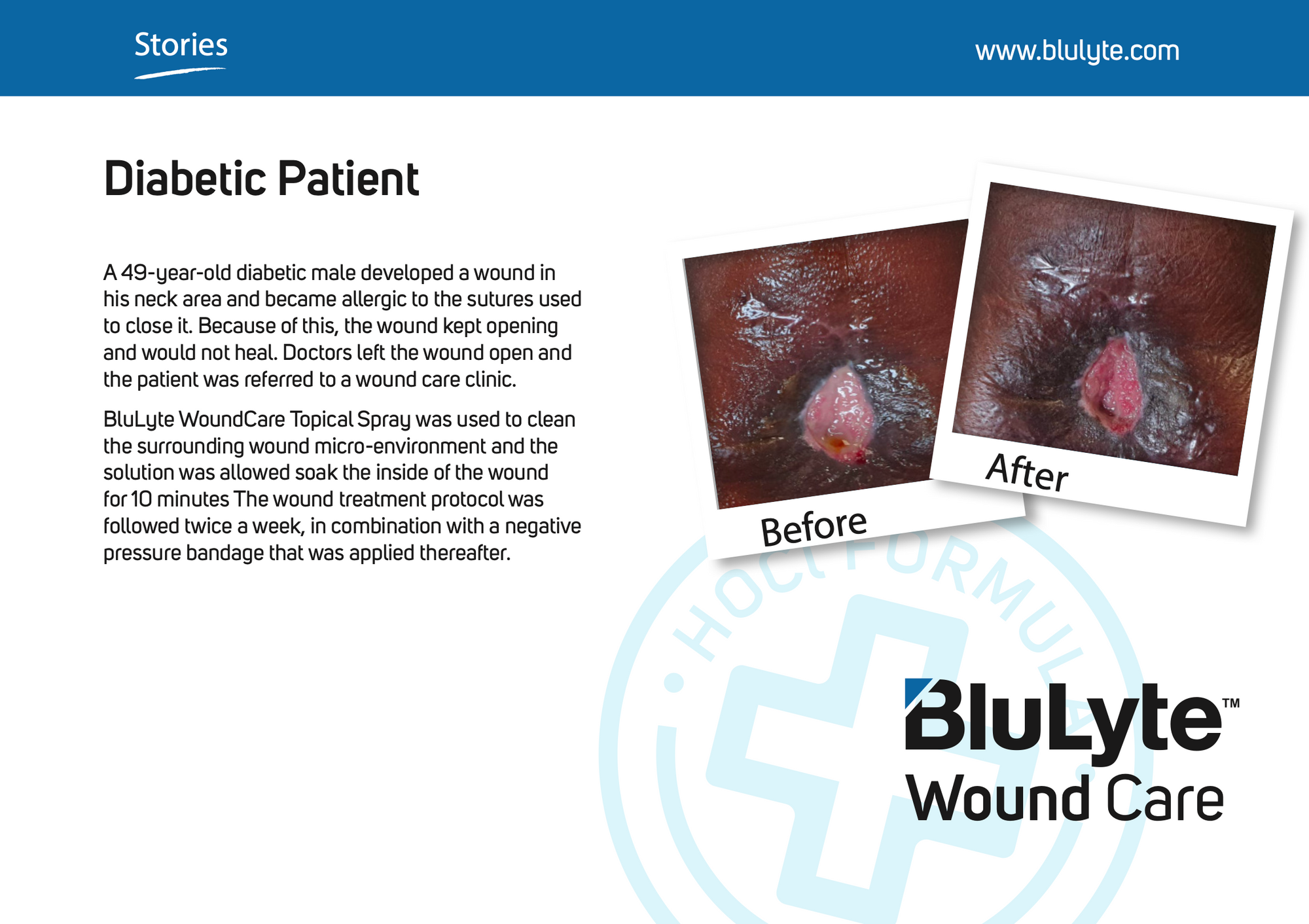 Case Study for BluLyte Wound Care showing a 'Before' and 'After' comparison of a diabetic patient's wound. Hypochlorous Acid