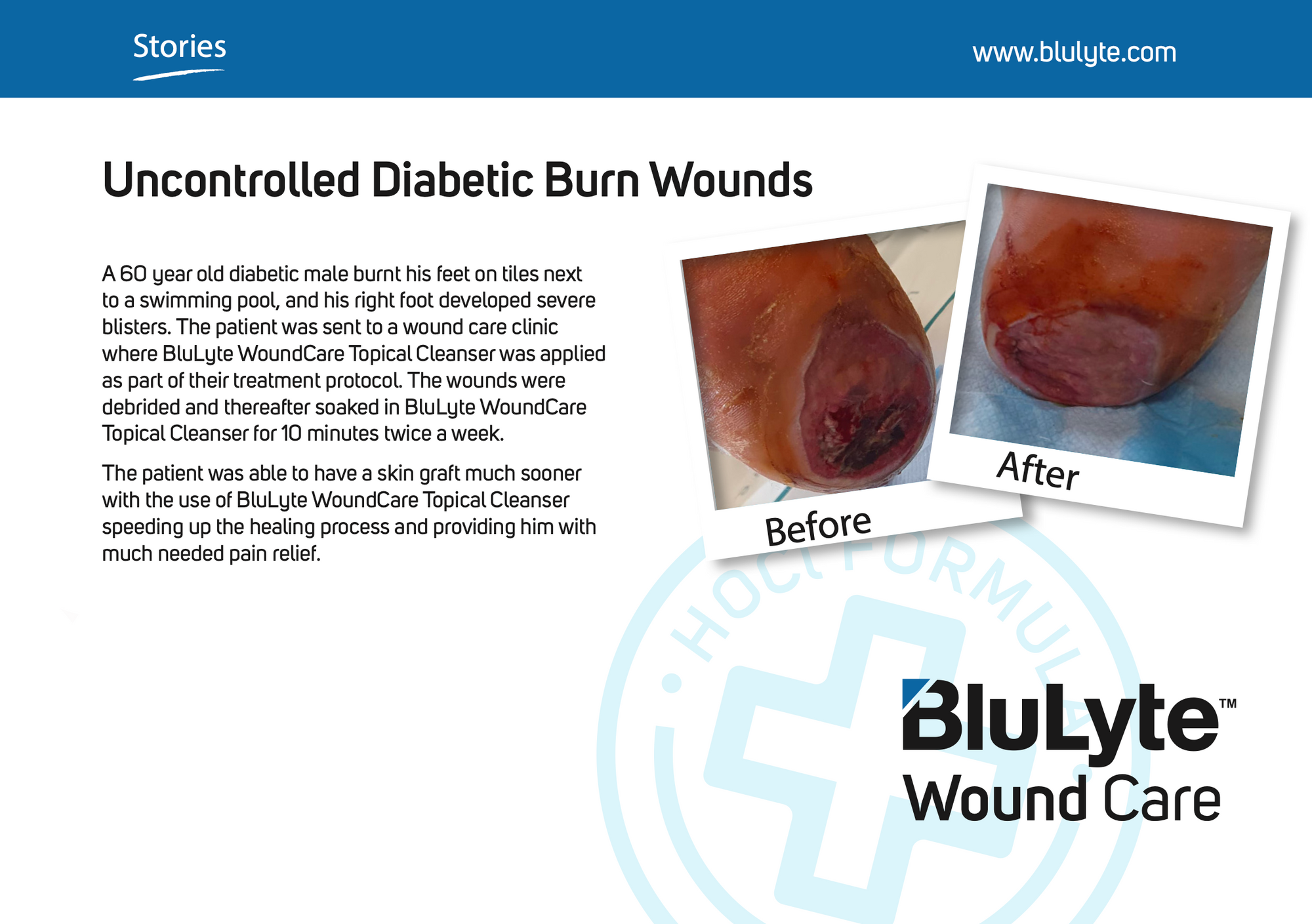Case Study for BluLyte Wound Care showing before and after images of diabetic burn wounds. Hypochlorous Acid