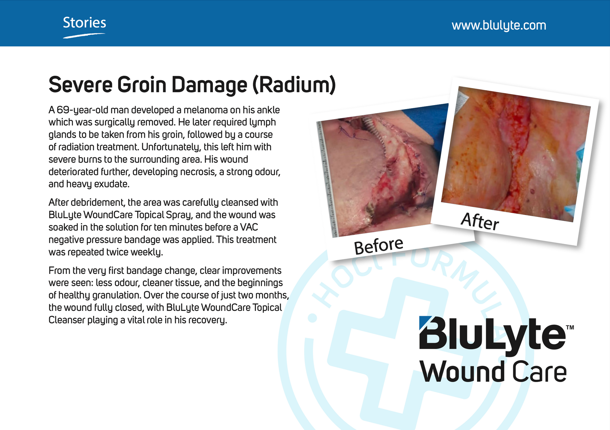 Case Study for BluLyte Wound Care showing before and after images of severe groin damage. Hypochlorous Acid