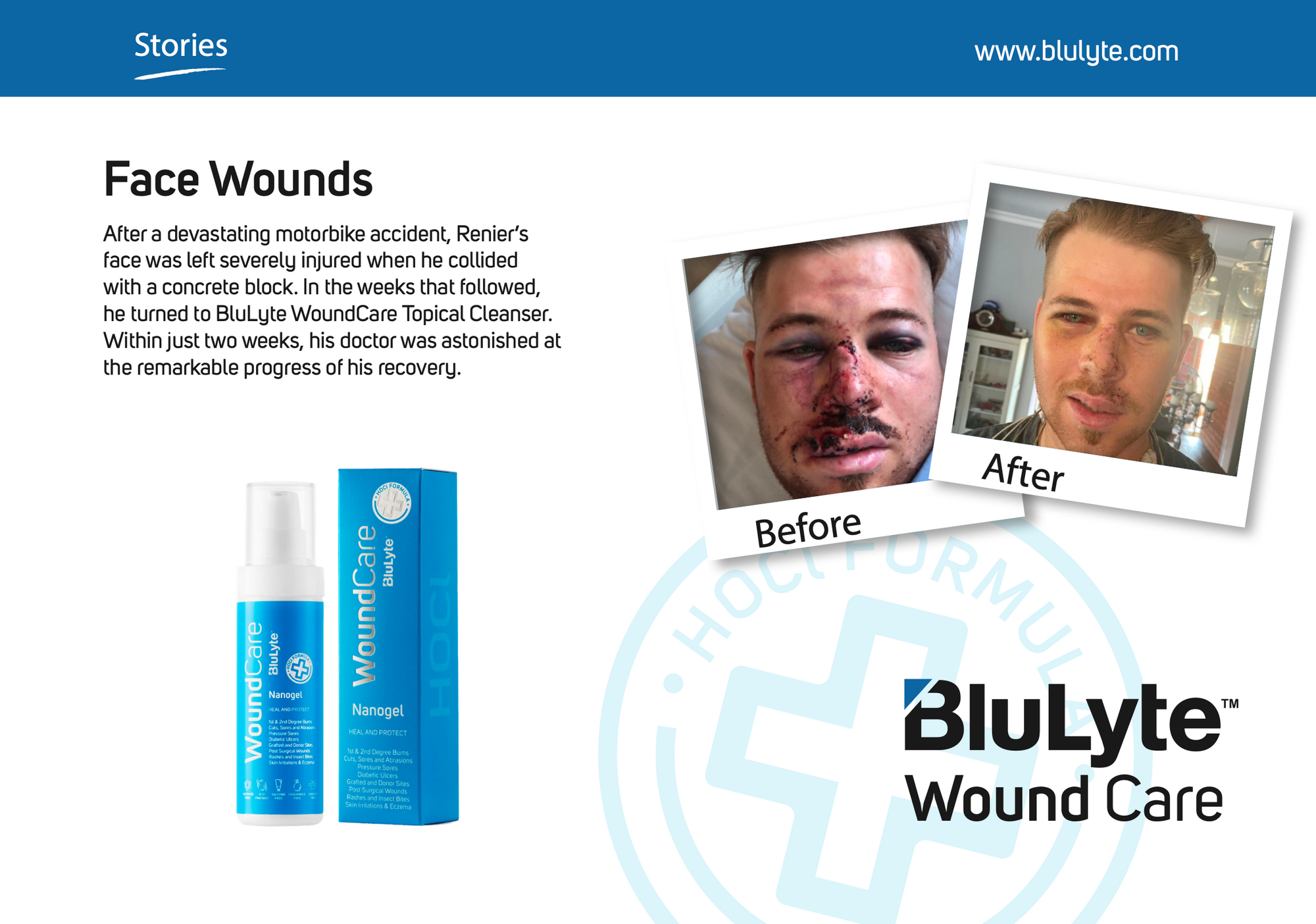 Case Study for BluLyte Wound Care with 'Before' and 'After' images of a face after a severe motorbike accident. Hypoclorous Acid.