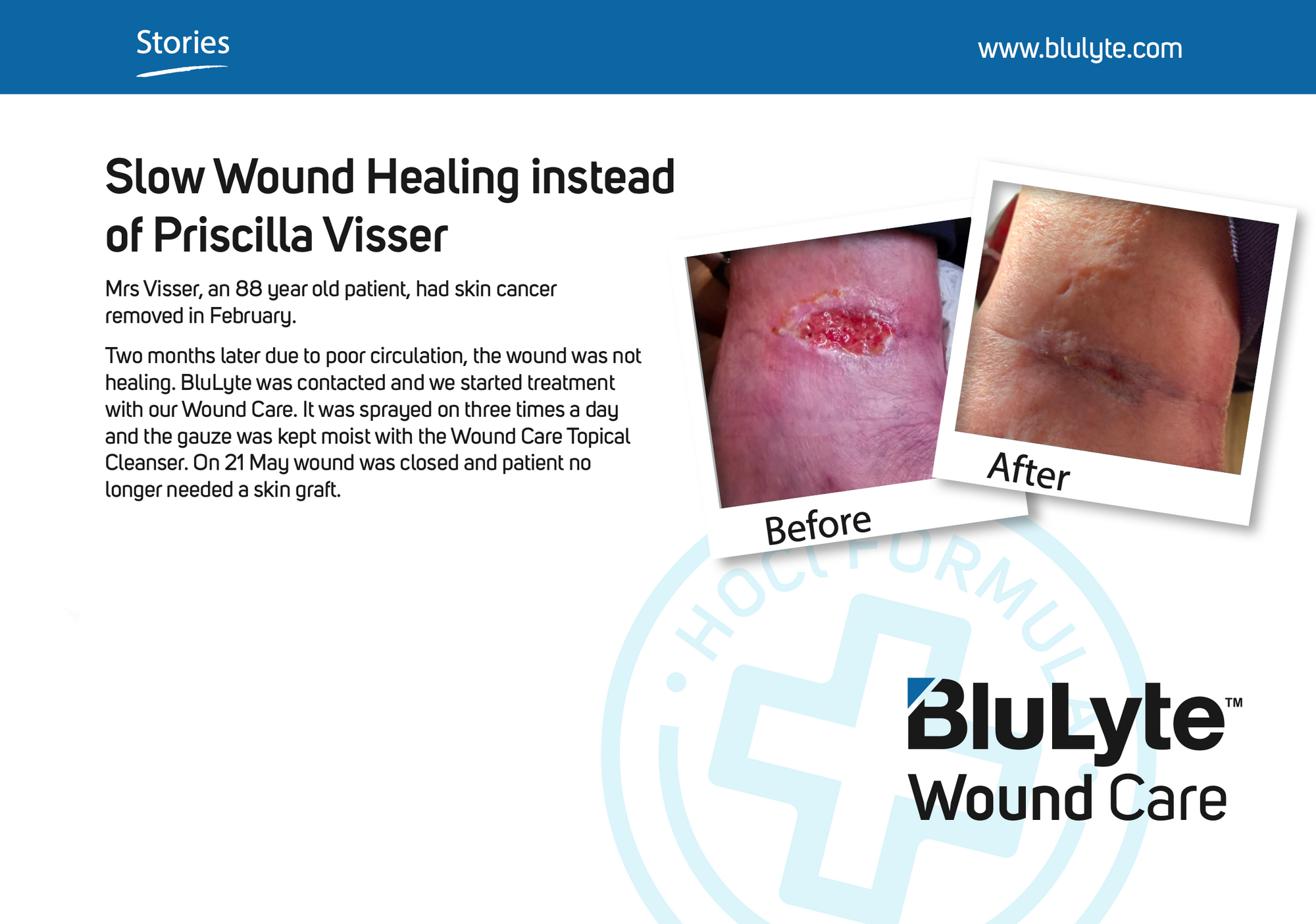 Case study for BluLyte Wound Care showing before and after images of a wound. Hypochlorous Acid