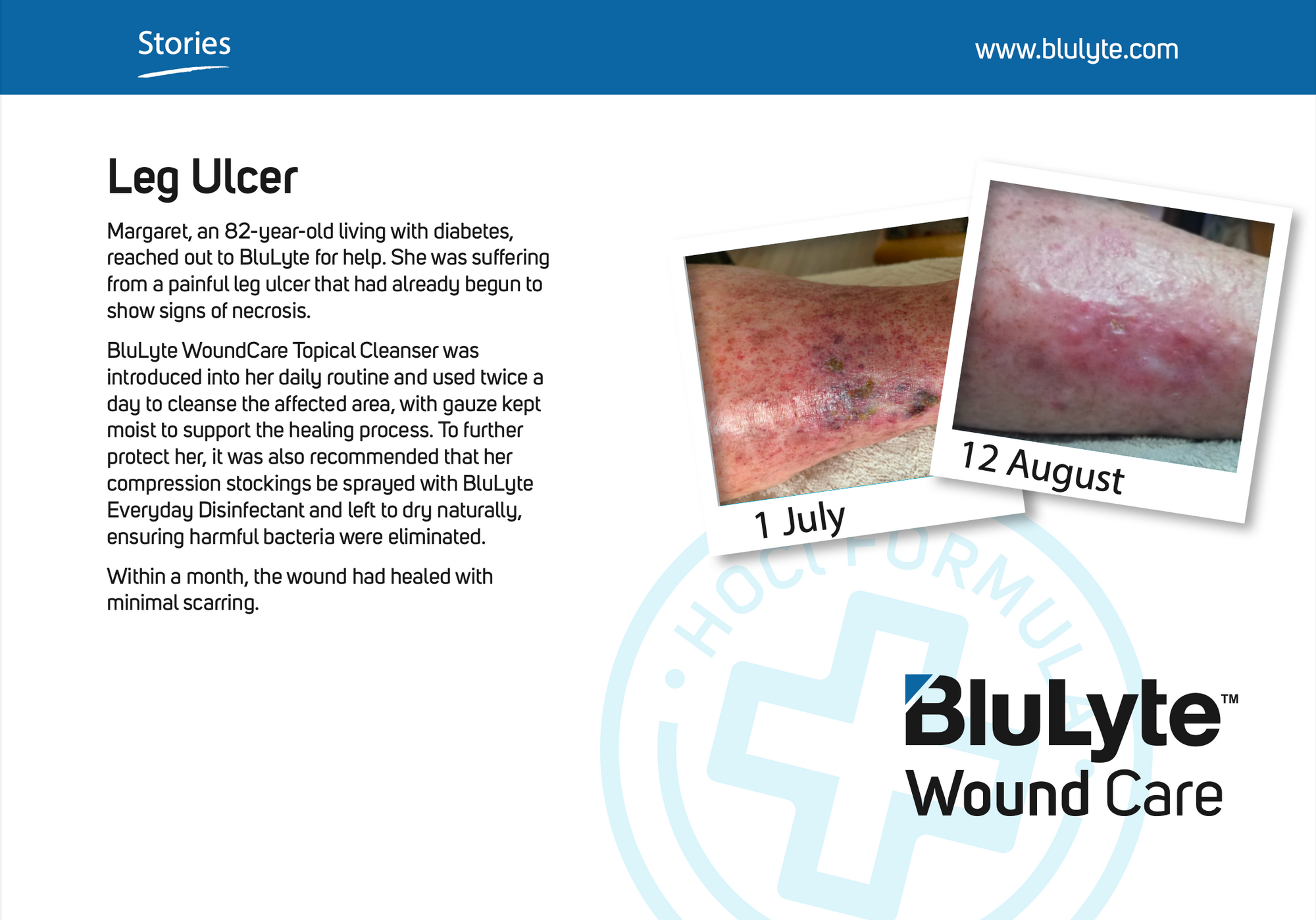 Case Study for BluLyte Wound Care  with before and after images of a leg ulcer. Hypochlorous Acid.