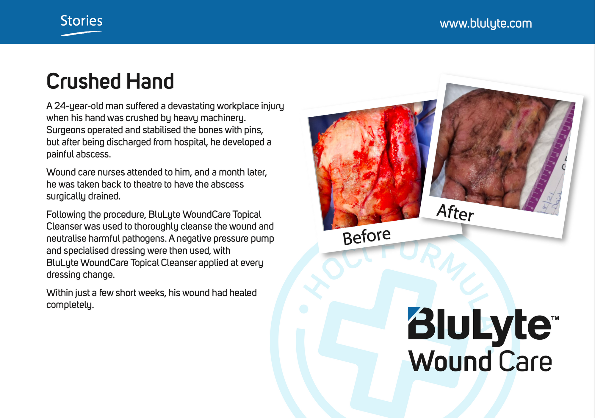 Case Study for BluLyte Wound Care with 'Before' and 'After' images of crushed hand. Hypochlorous Acid