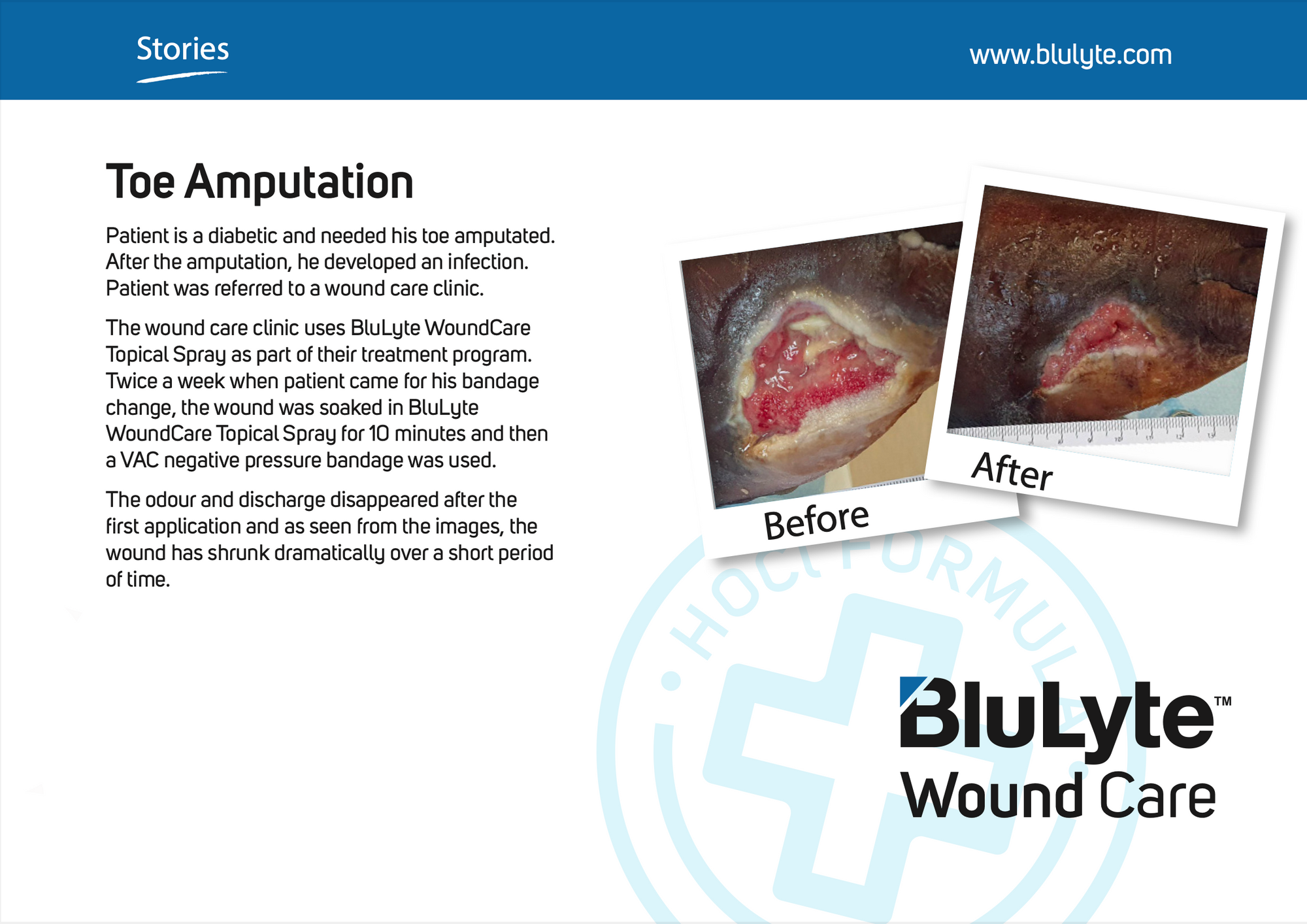 Case Study for BluLyte Wound Care with 'Before' and 'After' images of a toe amputation. Hypochlorous Acid.